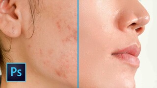 How to Remove Acne and Have Smooth Skin on Photoshop | SUPER FAST & EASY!!!