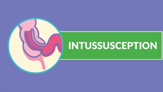 Intussusception