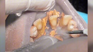 Haven't brushed my teeth for 10 years—time to give them a good clean all at once!