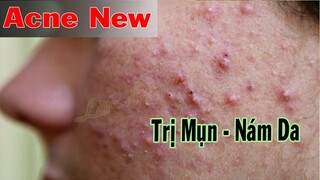 Acne Melasma P3 | Trị Mụn Nám bằng LÊ P3 - SacDepSpa#346