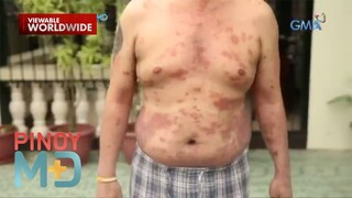 Sanhi ng pagkakaroon ng sakit na Psoriasis, alamin! | Pinoy MD