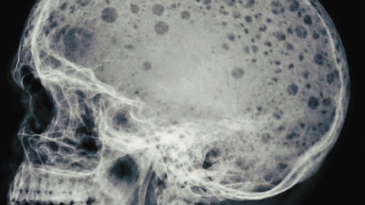 Why Does a Skull X-ray Show Dozens of Small Round Dark Lesions? Complete Radiological Breakdown of t