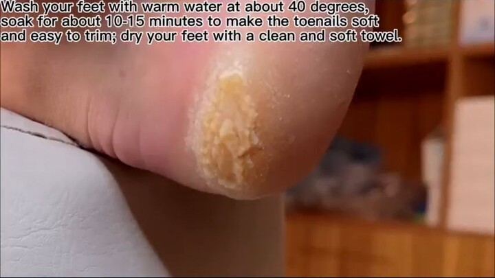 Professional heel treatment_R