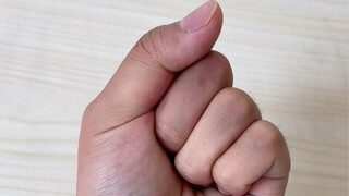 لدي أربعة أصابع فقط وأشعر بالإحباط منذ سنوات.