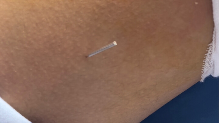 Đây có phải là hiện tượng kinh lạc không? Mọi người hãy thảo luận một cách lý trí nhé!