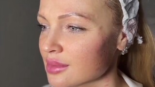 What kind of rejuvenation technique is this⁉️