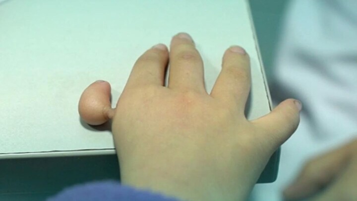 大拇指快要掉了，手术后小男孩拿笔写字