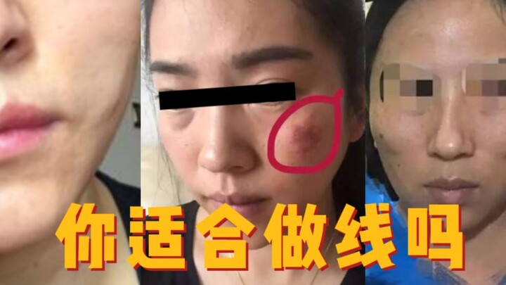 تأثير الشد بالخيوط ضد الشيخوخة ممتاز، لكنه لا يناسب الجميع.