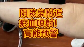 High-energy jet warning! Practical explanation of bloodletting at the lesion site near the Yinlingqu