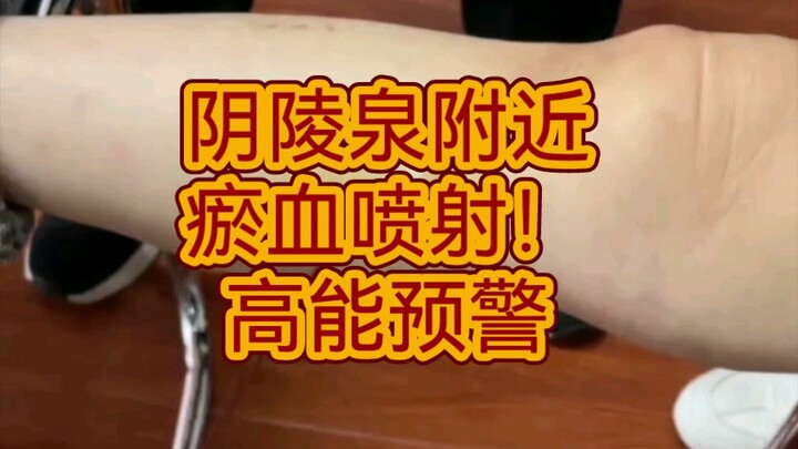 高能喷射预警！阴陵泉地机附近病变点放血实操讲解。