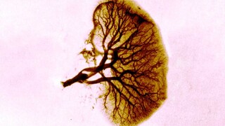 This is what happened to a woman's kidneys after she ate a spoiled hamburger for dinner.