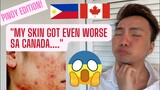 MY SKIN GOT EVEN WORSE IN CANADA | PINOY EDITION | BUHAY CANADA