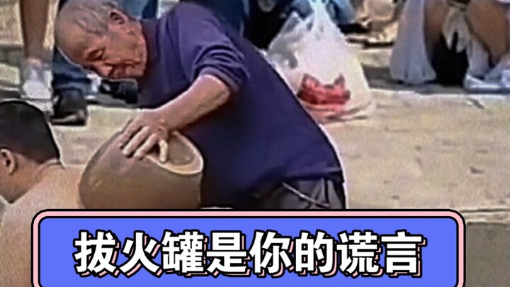 “Cupping Is Just Your Lie”