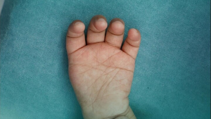 เจ้าตัวน้อยที่มีแค่ 4 นิ้ว คุณหมอจะช่วยทำนิ้วโป้งให้หนูเอง!