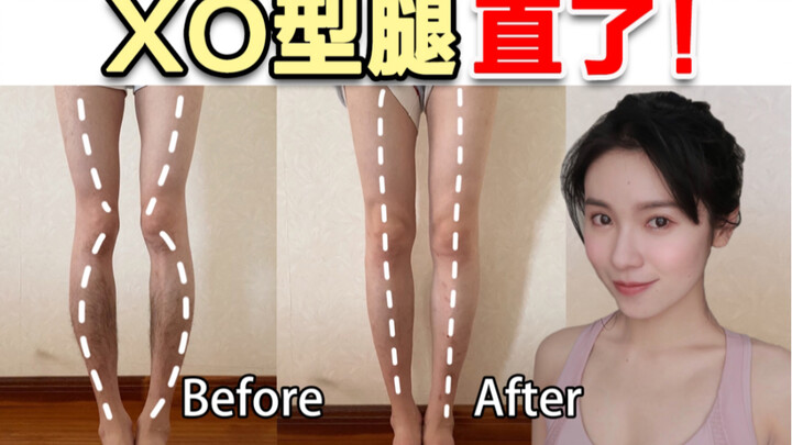 20年XO型腿还有救！超详细直腿教程 每天跟练 一个月肉眼见效果