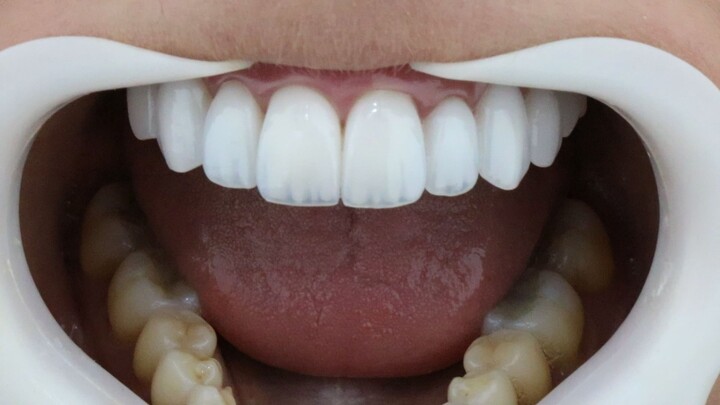Lente dental