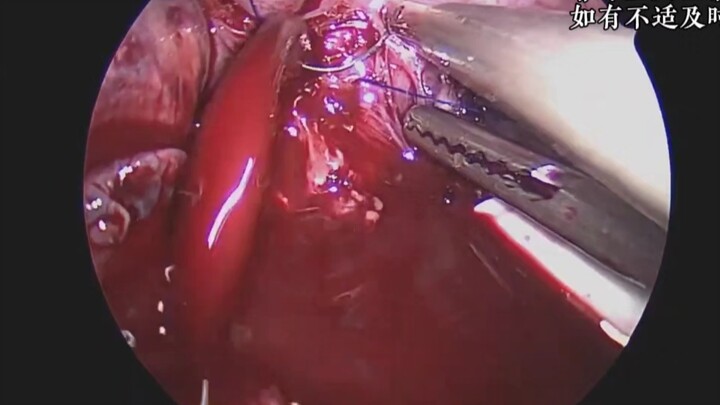 Intraoperative Bleeding and Management (Surgical Case—View with Caution)