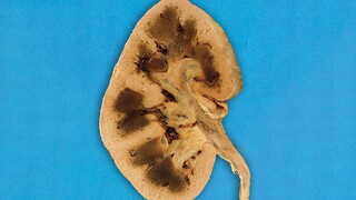 A boy puts on his dirty socks on a hot summer morning. This is what happens to his kidneys.