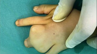 How did this child's hand heal? He said the girl's "hand was reborn" after the operation