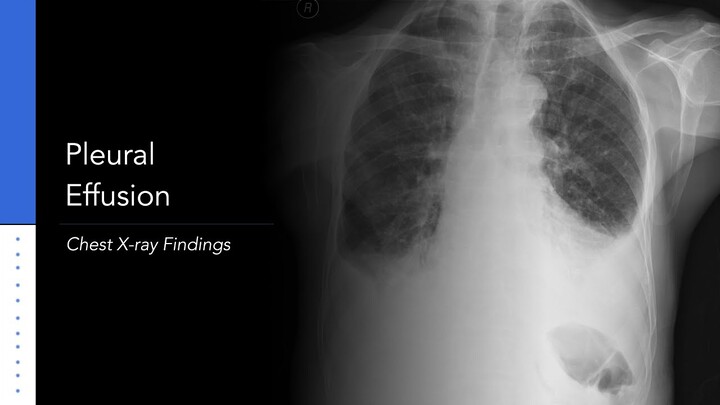 Pleural Effusion: Explanation of X-ray Findings