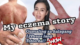 Mabisang Gamot sa Eczema | Murang Gamot sa Skin alergy, sugat-sugat at Kati-kati sa Kamay