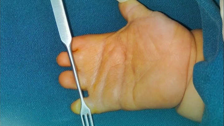 Mười năm ngày nào cũng ngồi phòng khám phẫu thuật, bác sĩ biến đôi tay nhỏ bé của bé mở ra như có ph