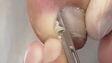 Satisfying Ingrown toenail removal treatment #toenail #ingrown