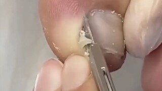 Satisfying Ingrown toenail removal treatment #toenail #ingrown