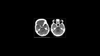 signos de Infarto o isquemia arterial