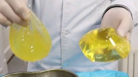 في سن الـ66، جاءت لإزالة غرسة صدرية داخلية، وهي غرسة بلا معايير لمدة تزيد عن 20 عامًا، وعند إزالتها 