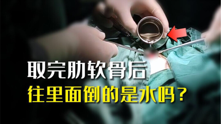 After the rib cartilage is harvested, is what they pour inside just water? #Nose #Beauty #Comprehens