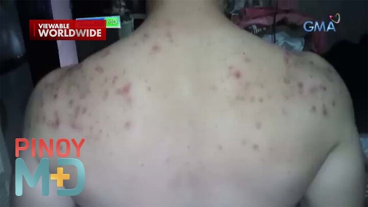 Paano mawawala ang back acne? | Pinoy MD