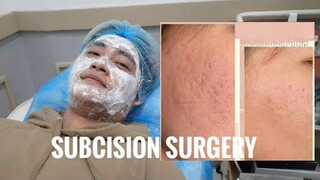 HOW TO REMOVE ACNE SCARS EFFECTIVELY!!! (SUBCISION)