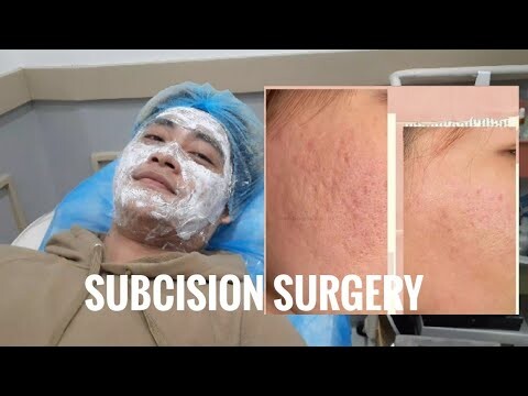 HOW TO REMOVE ACNE SCARS EFFECTIVELY!!! (SUBCISION)
