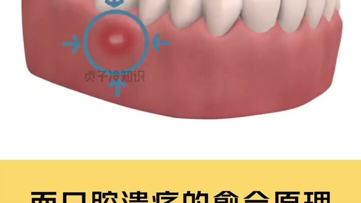 Bạn có biết khắc tinh của vết loét là gì không?