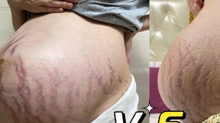[Postpartum Diary] The cost of giving birth to stretch marks (continuously updated)