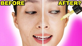 I Used A Chemical Peel On Only Half Of My Face For 1 Week