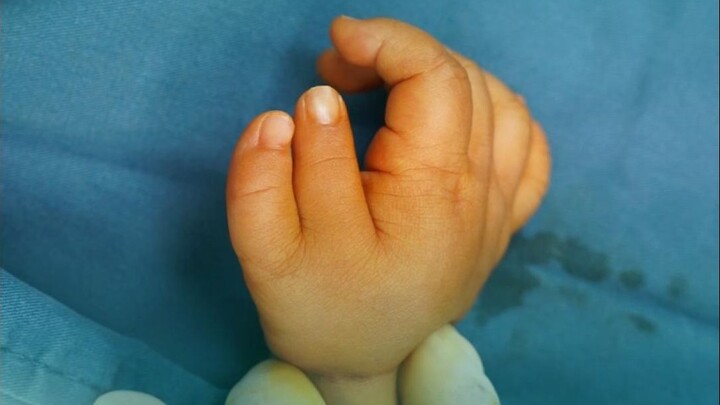 Mana yang sebaiknya dipertahankan dari dua ibu jari? Dokter: Salah memotong bisa berakibat sangat se