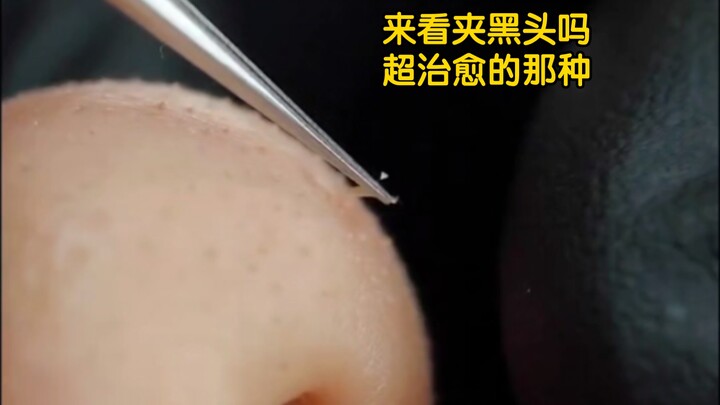 Want to see blackhead extraction? It's super soothing!