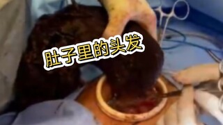 25-year-old woman eats tons of hair, find out how to get it out