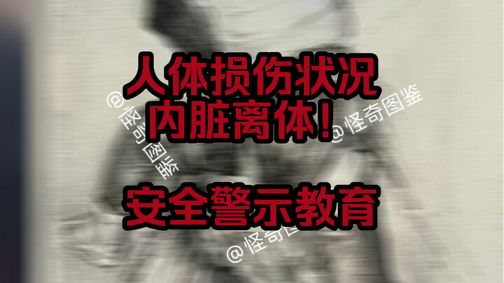 Cảnh báo an toàn! Trường hợp thực tế (người yếu bóng vía không nên xem)