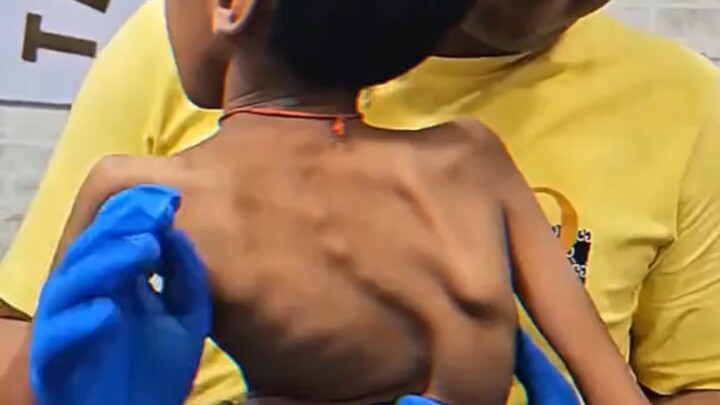 Thần y chỉnh xương: Chỉnh sửa vẹo cột sống