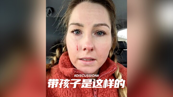 My face was scratched in an attempt to discipline my child.