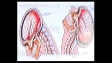 Patologías cerebrales causadas por golpes