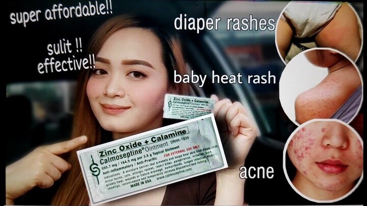 AFFORDABLE AND EFFECTIVE TREATMENT PARA SA RASHES NI BABY | TREATMENT FOR ACNE.