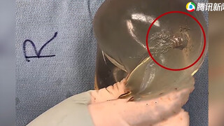 姑娘街头突遭枪击打中胸部 万幸的是胸部硅胶救了一命