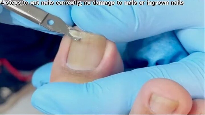 Professional ingrown toenail treatment_R