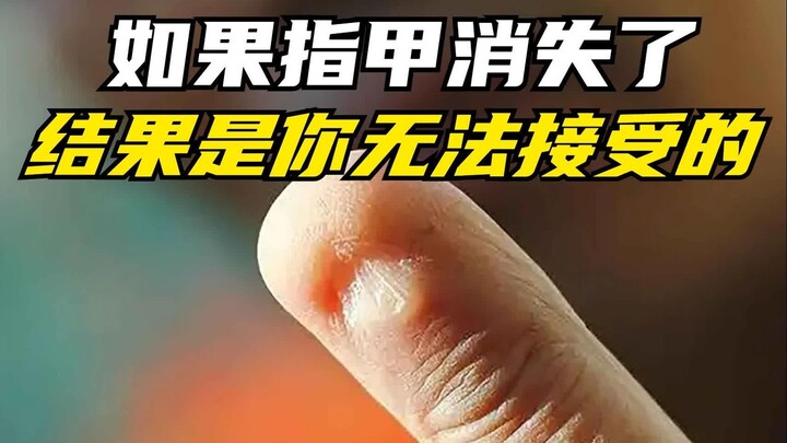 Nếu móng tay biến mất, liệu nó có ảnh hưởng đến cuộc sống hàng ngày của chúng ta không? Kết quả sẽ k