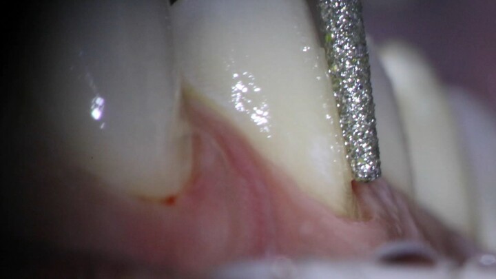 Preparo pra lente dental