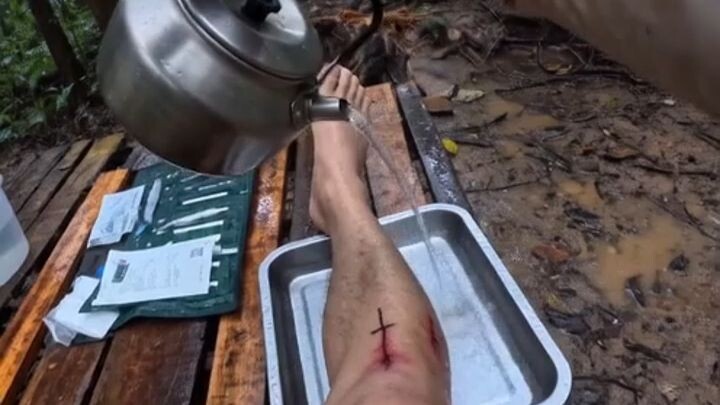 “Nguy cơ nhiễm trùng vết thương ở cẳng chân”